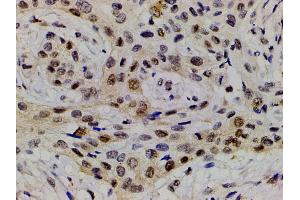 ABIN6267554 at 1/200 staining human esophageal carcinoma tissue sections by IHC-P.
