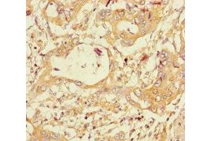 Immunohistochemistry of paraffin-embedded human pancreatic cancer using ABIN7160703 at dilution of 1:100 (PGLYRP2 antibody  (AA 22-576))