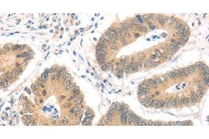 Immunohistochemistry of paraffin-embedded Human colon cancer using MAGED1 Polyclonal Antibody at dilution of 1:30 (MAGED1 antibody)
