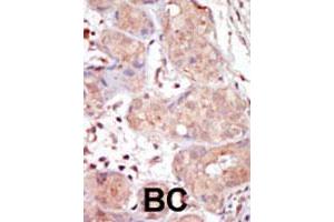 Formalin-fixed and paraffin-embedded human cancer tissue reacted with MAK polyclonal antibody  , which was peroxidase-conjugated to the secondary antibody, followed by DAB staining. (MAK antibody  (C-Term))