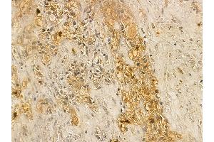 AWAT2 Mouse Monoclonal Antibody at 1/100 staining human kidney cancer by IHC-P. (AWAT2 antibody  (Internal Region))