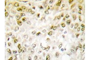 Immunohistochemistry analyzes of Chk1 antibody in paraffin-embedded human breast carcinoma tissue. (CHEK1 antibody)