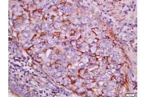 Formalin-fixed and paraffin embedded human lung carcinoma labeled with Rabbit Anti-pan-Cytokeratin Polyclonal Antibody, Unconjugated  at 1:200 followed by conjugation to the secondary antibody and DAB staining (Cytokeratin 1 antibody  (AA 101-200))