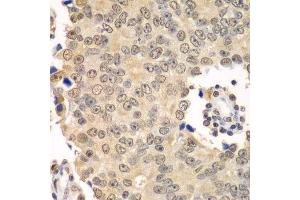 Immunohistochemistry of paraffin-embedded human prostate cancer using HDAC2 antibody. (HDAC2 antibody  (C-Term))