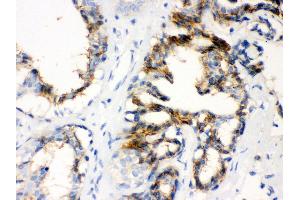 Anti- CTGF Picoband antibody, IHC(P) IHC(P): Human Mammary Cancer Tissue (CTGF antibody  (AA 58-349))