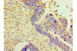 Immunohistochemistry of paraffin-embedded human ovarian cancer using ABIN7150514 at dilution of 1:100 (DNAJB2 antibody  (AA 2-324))