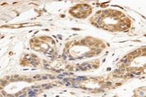 Immunohistochemistry analysis of paraffin-embedded human breast cancer using TPPP3 (ABIN7076047) at dilution of 1: 3000 (TPPP3 antibody)