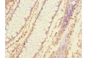 Immunohistochemistry of paraffin-embedded human colon cancer using ABIN7173776 at dilution of 1:100