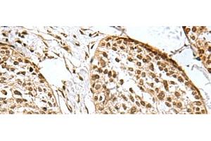 Immunohistochemistry of paraffin-embedded Human esophagus cancer tissue using H2AFJ Polyclonal Antibody at dilution of 1:170(x200) (H2AFJ antibody)