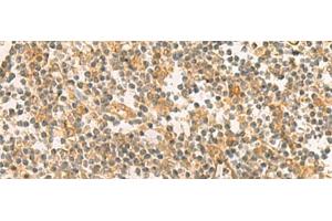 Immunohistochemistry of paraffin-embedded Human tonsil tissue using PPM1M Polyclonal Antibody at dilution of 1:100(x200) (PPM1M antibody)