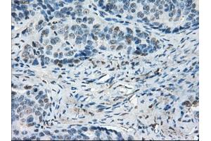 Immunohistochemical staining of paraffin-embedded Adenocarcinoma of colon tissue using anti-LTA4H mouse monoclonal antibody. (LTA4H antibody)