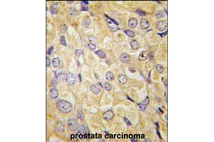 Formalin-fixed and paraffin-embedded human prostate carcinoma tissue reacted with FZD1 polyclonal antibody  , which was peroxidase-conjugated to the secondary antibody, followed by DAB staining. (FZD1 antibody  (Internal Region))