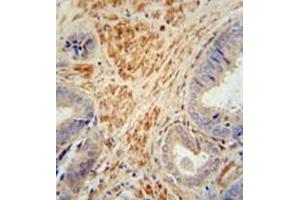 Immunohistochemistry analysis in formalin fixed and paraffin embedded human prostate carcinoma reacted with FSTL1 Antibody (C-term) followed by peroxidase conjugation of the secondary antibody and DAB staining.