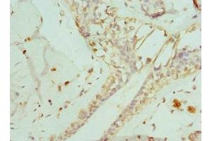 Immunohistochemistry of paraffin-embedded human breast cancer using ABIN7151371 at dilution of 1:100 (ENTPD2 antibody  (AA 28-268))