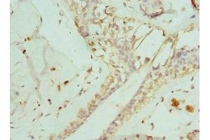 Immunohistochemistry of paraffin-embedded human breast cancer using ABIN7151371 at dilution of 1:100 (ENTPD2 antibody  (AA 28-268))