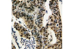 Anti-TNFAIP1 antibody, IHC(P) IHC(P): Human Rectal Cancer Tissue