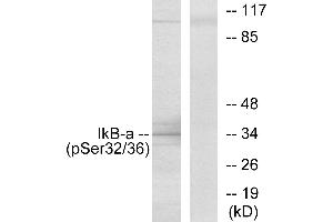 Immunohistochemistry analysis of paraffin-embedded human breast carcinoma tissue using IκB-α (Phospho-Ser32/Ser36) antibody. (NFKBIA antibody  (pSer32, pSer36))