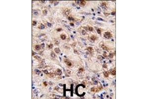 Formalin-fixed and paraffin-embedded human hepatocarcinoma tissue reacted with MINA (C-term) (ABIN387880 and ABIN2844089) , which was peroxidase-conjugated to the secondary antibody, followed by DAB staining. (MINA antibody  (C-Term))
