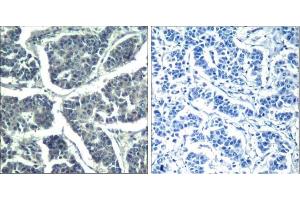 Immunohistochemical analysis of paraffin-embedded human breast carcinoma tissue using PLC-γ2 (phospho-Tyr1217) Antibody (E011524). (Phospholipase C gamma 2 antibody  (pTyr1217))