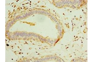 Immunohistochemistry of paraffin-embedded human breast cancer using ABIN7153568 at dilution of 1:100