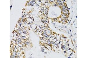 Immunohistochemistry of paraffin-embedded Human gastric cancer using CHN1 Polyclonal Antibody at dilution of 1:100 (40x lens). (CHN1 antibody)