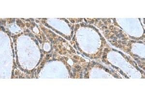 Immunohistochemistry of paraffin-embedded Human thyroid cancer tissue using CNTN4 Polyclonal Antibody at dilution of 1:65(x200) (Contactin 4 antibody)