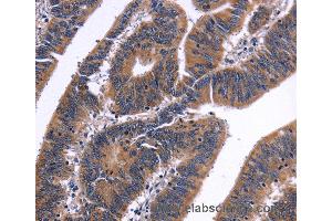 Immunohistochemistry of Human liver cancer using NFATC3 Polyclonal Antibody at dilution of 1:50