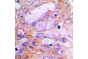 Immunohistochemical analysis of Caspase 12 staining in human lung cancer formalin fixed paraffin embedded tissue section. (Caspase 12 antibody  (Center))