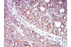 Immunohistochemical analysis of paraffin-embedded cervical cancer tissues using CD102 mouse mAb with DAB staining.
