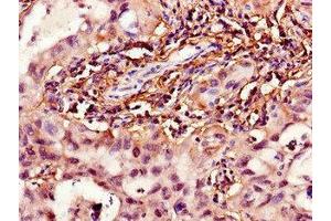 Immunohistochemistry of paraffin-embedded human lung cancer using ABIN7142110 at dilution of 1:100 (HPGD antibody  (AA 14-130))