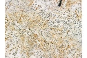 ABIN6263601 and ABIN6276613 at 1/100 staining human gastric carcinoma by IHC-P. (NET1 antibody  (C-Term))