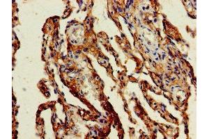 Immunohistochemistry of paraffin-embedded human lung cancer using ABIN7154472 at dilution of 1:100 (GADD45G antibody  (AA 1-159))