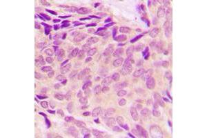 Immunohistochemical analysis of RPL37A staining in human breast cancer formalin fixed paraffin embedded tissue section. (RPL37A antibody  (Center))