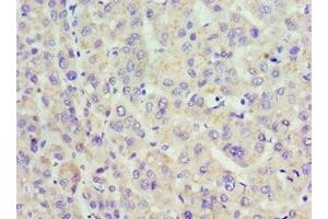 Immunohistochemistry of paraffin-embedded human liver cancer using ABIN7142321 at dilution of 1:100