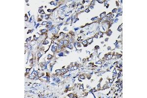 Immunohistochemistry of paraffin-embedded human lung cancer using GSTK1 Rabbit pAb (ABIN1680136, ABIN3019398, ABIN3019399 and ABIN6220875) at dilution of 1:25 (40x lens).