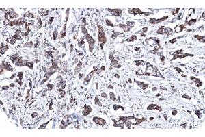 IHC-P Image Immunohistochemical analysis of paraffin-embedded human breast cancer, using MAP2K2, antibody at 1:100 dilution. (MEK2 antibody)