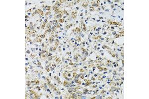 Immunohistochemistry of paraffin-embedded human uterine cancer using TXN2 antibody (ABIN2560616) at dilution of 1:100 (40x lens). (TXN2 antibody)