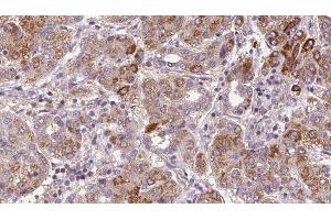 ABIN6272365 at 1/100 staining Human liver cancer tissue by IHC-P. (NMUR1 antibody  (N-Term))