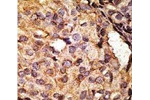 IHC analysis of FFPE human breast carcinoma tissue stained with the TLR6 antibody (TLR6 antibody  (AA 722-753))