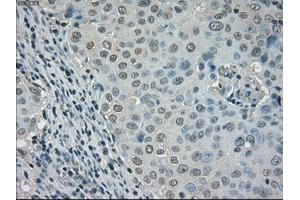 Immunohistochemical staining of paraffin-embedded Adenocarcinoma of ovary tissue using anti-DHFRmouse monoclonal antibody. (Dihydrofolate Reductase antibody)