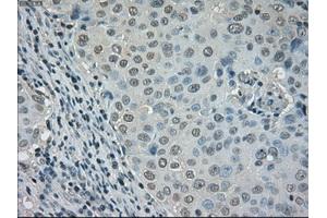 Immunohistochemical staining of paraffin-embedded Adenocarcinoma of ovary tissue using anti-DHFRmouse monoclonal antibody.