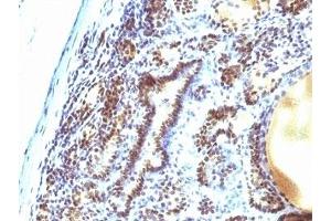 Formalin-fixed, paraffin-embedded human thyroid carcinoma stained with MAP3K1 antibody (2F6). (MAP3K1 antibody  (AA 1211-1310))