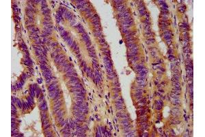IHC image of ABIN7152698 diluted at 1:800 and staining in paraffin-embedded human colon cancer performed on a Leica BondTM system. (FERMT1 antibody  (AA 321-420))