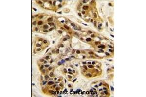 Formalin-fixed and paraffin-embedded human breast carcinoma tissue reacted with PRMT1 antibody (C-term ), which was peroxidase-conjugated to the secondary antibody, followed by DAB staining. (PRMT1 antibody  (C-Term))