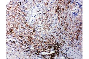 Anti-LTBR antibody, IHC(P) IHC(P): Human Intestinal Cancer Tissue (LTBR antibody  (C-Term))