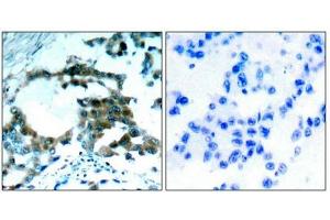 Immunohistochemical analysis of paraffin-embedded human lung carcinoma tissue using PKCth(Phospho-Ser695) Antibody(left) or the same antibody preincubated with blocking peptide(right). (PKC theta antibody  (pSer695))