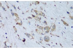 Immunohistochemistry of paraffin-embedded Human gastric cancer using ENPP3 Polyclonal Antibody at dilution of 1:150 (40x lens). (ENPP3 antibody)