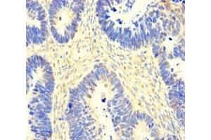 Immunohistochemistry of paraffin-embedded human ovarian cancer using ABIN7163155 at dilution of 1:100 (SACM1L antibody  (AA 301-520))
