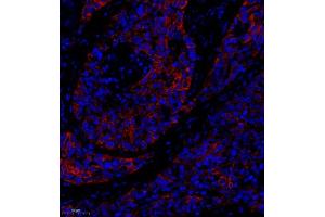 Immunofluorescence of paraffin embedded human lung cancer using MRP1 (ABIN7074544) at dilution of 1:1000 (250x lens) (MRP1 antibody)