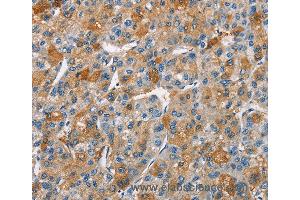 Immunohistochemistry of Human liver cancer using BCL10 Polyclonal Antibody at dilution of 1:40 (BCL10 antibody)